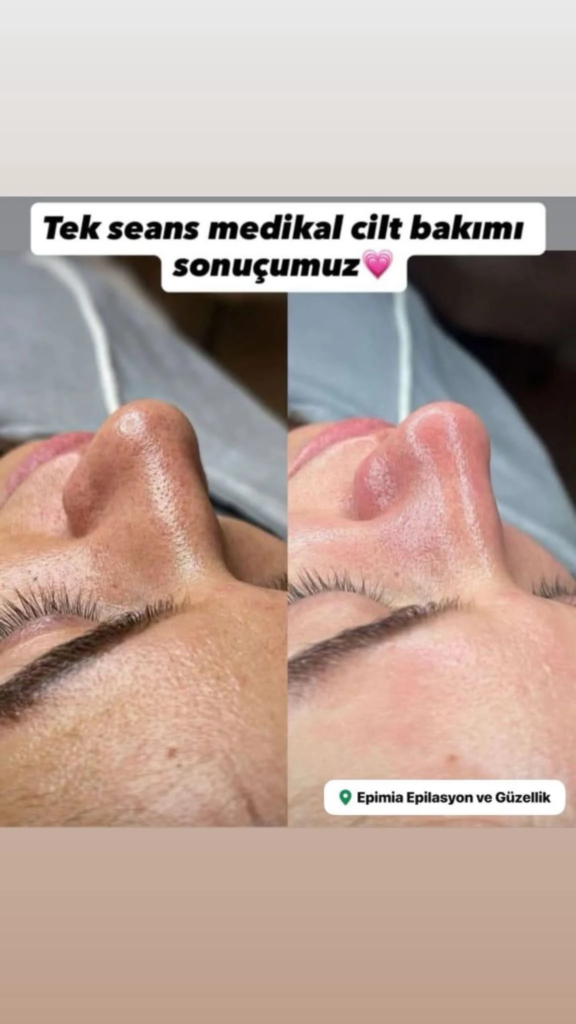 Epimia Medikal Cilt Bakımı sonuç görseli